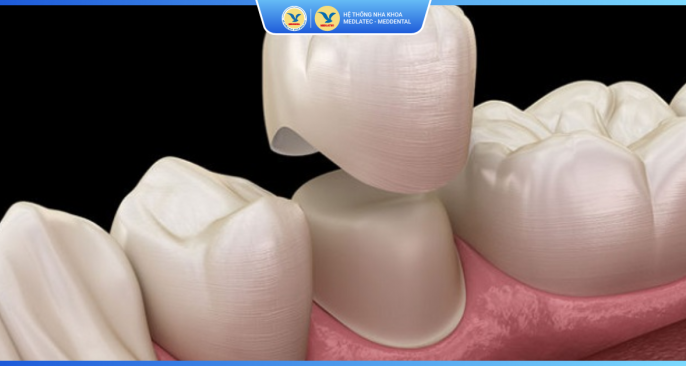Bảng giá dịch vụ bọc răng sứ thẩm mỹ - phục hình